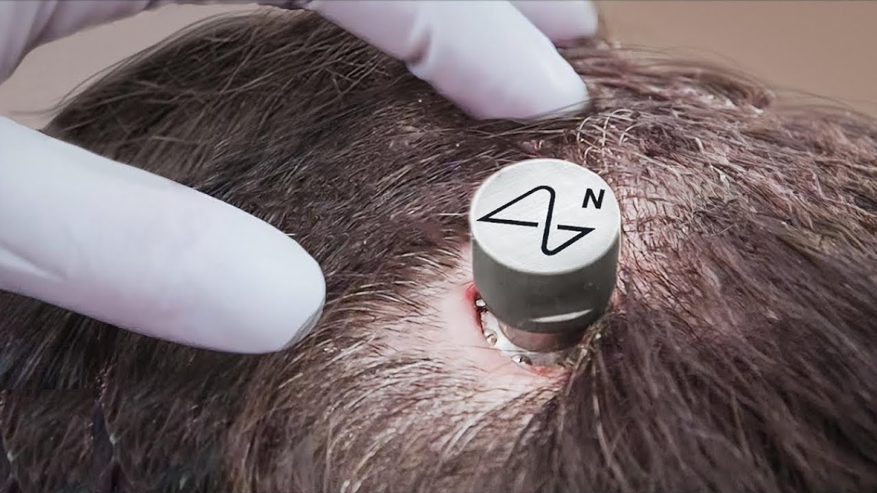 18 mēnešus pēc smadzeņu mikroshēmas implantācijas pirmais Elona Muska pacients, kurš izmanto Neuralink, dalās savā pieredzē.